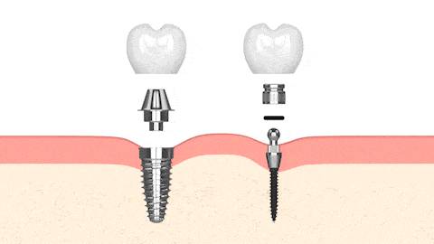 Conventional Implants vs Mini Dental Implants in Austin TX Dr. Brandon Hall