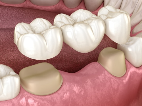 Puentes Dentales en Austin TX Dr. Brandon Hall