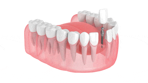 Mini Dental Implant Process Mini Dental Implants in Austin, TX