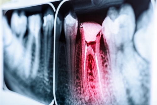 Root Canals in Austin, TX - Root Canal Therapy