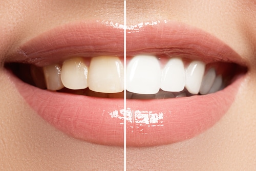 Teeth Whitening in Austin TX Dr. brandon Hall Aspire Dental