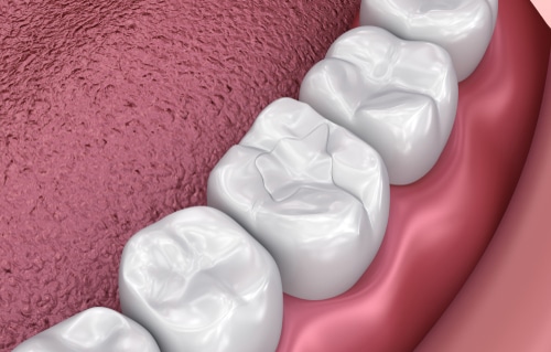 Composite Fillings