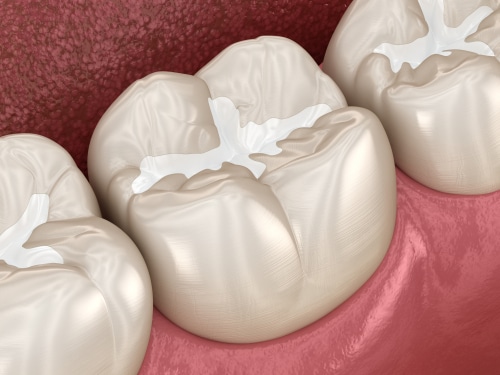 Selladores dentales en Austin, TX Dr. Brandon Hall Aspire Dental