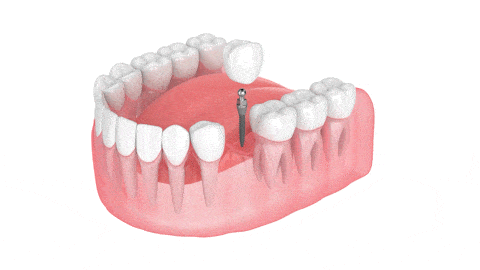 Implant Dentistry in Austin TX Dr. Brandon Hall Aspire Dental