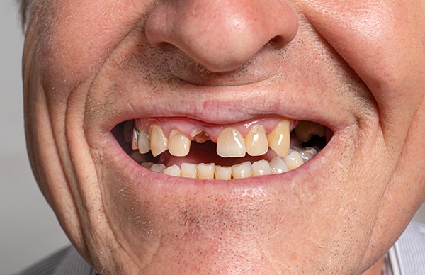 Mini X Teeth Options To Replace Multiple Teeth | Mini Dental Implants in Austin