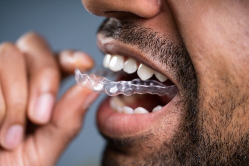 Alineadores transparentes en Austin, TX | Invisalign | Alternativas a los frenos