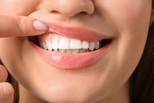 Encías sangrantes y por qué debes prestarles atención | Aspire Dental