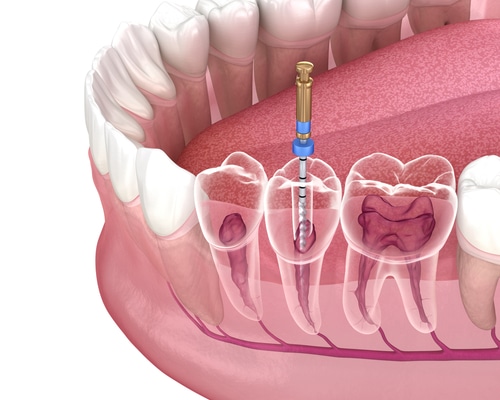 Endodoncia en Austin, TX Aspire Dental