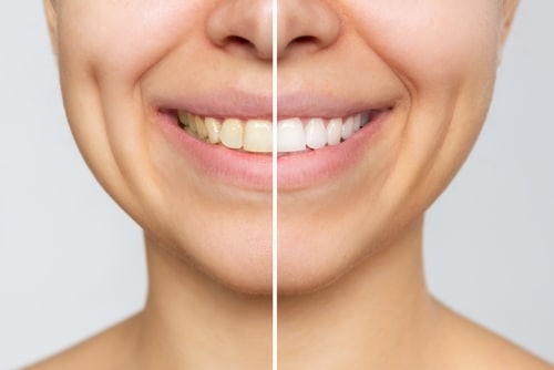 Teeth Whitening in Austin, TX Zoom Whitening Aspire Dental