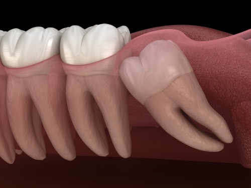 Wisdom Teeth Removal in Austin, TX Extraction Aspire Dental