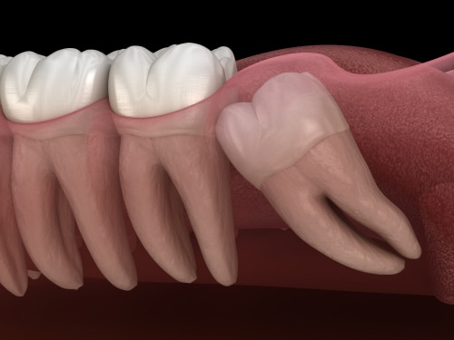 Extracción de Muelas del Juicio en Austin, TX Extracción Aspire Dental