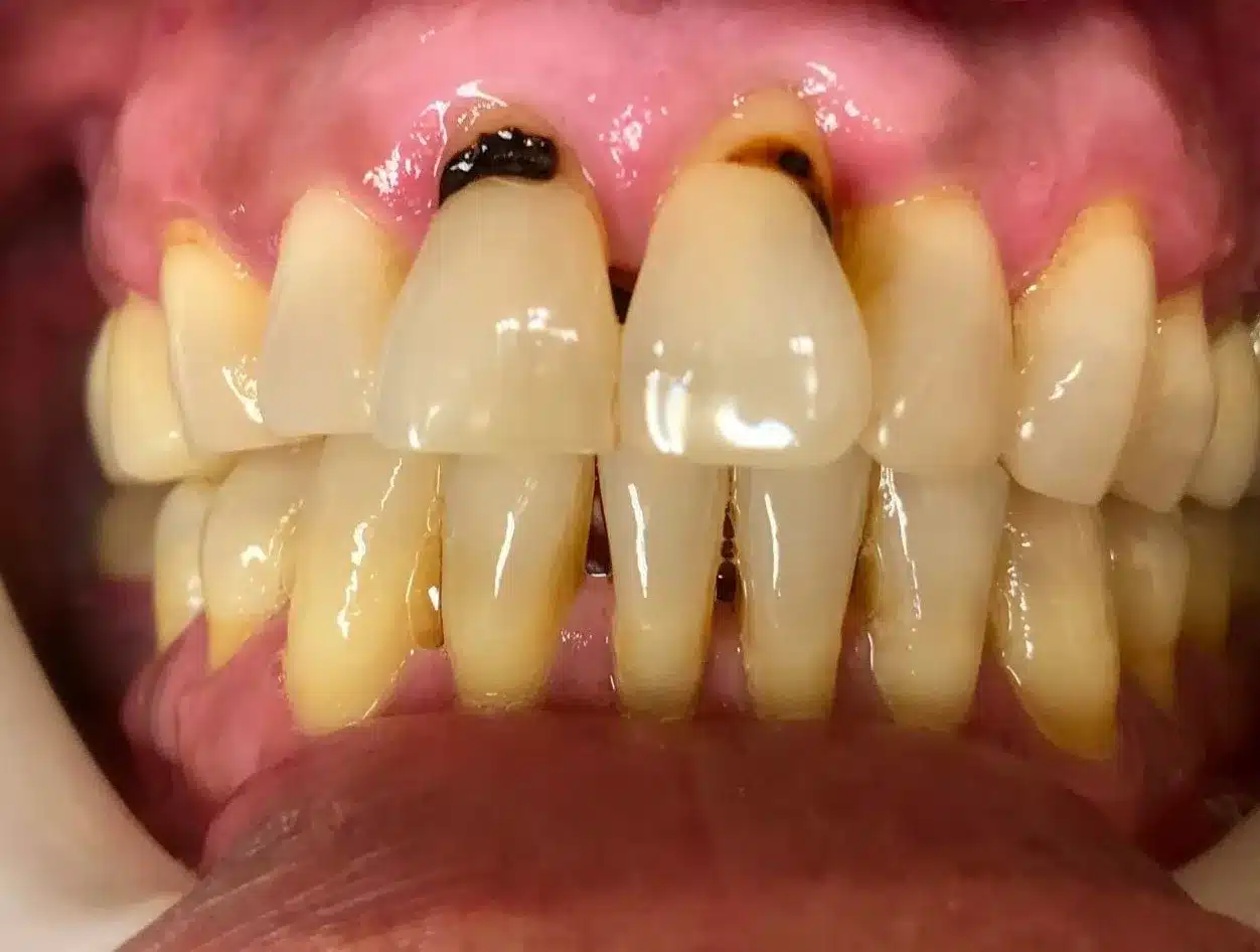Adhesión dental Antes