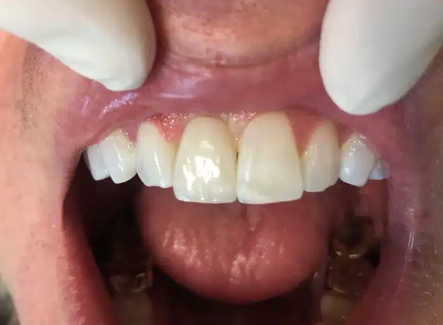 Implantes dentales estándar - Después