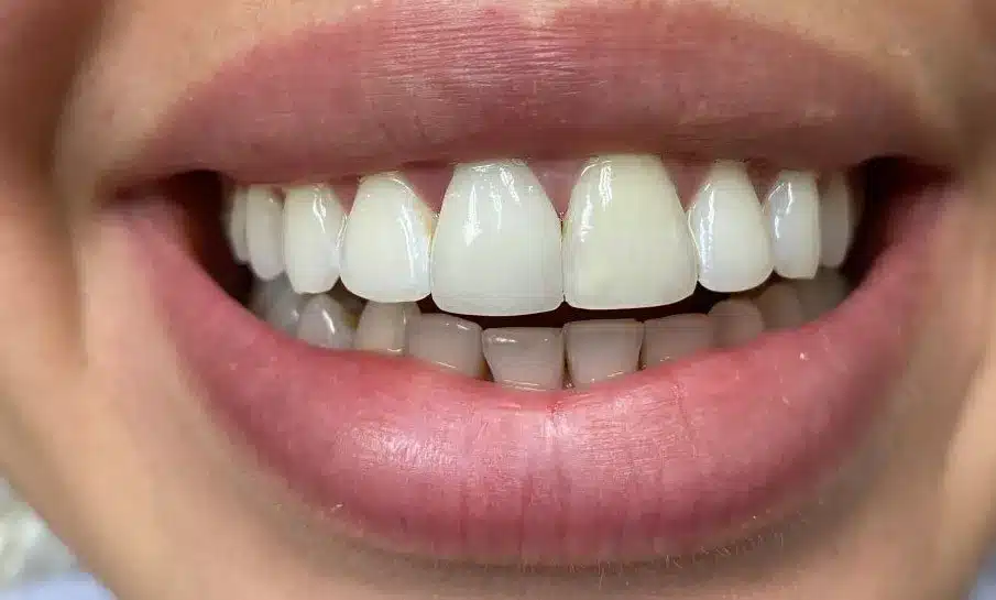 Standard Dental Implants - After