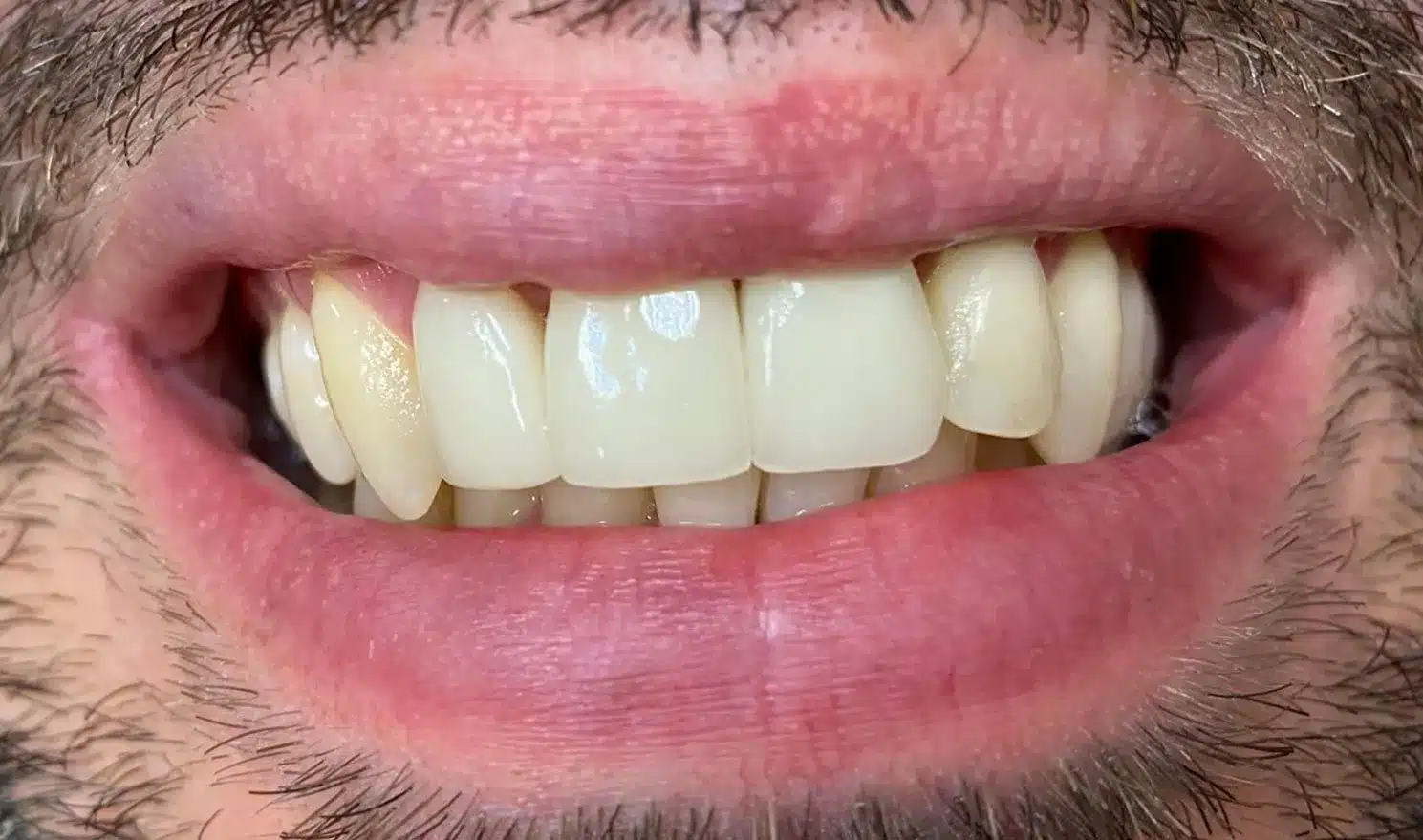 Implantes dentales estándar - Después