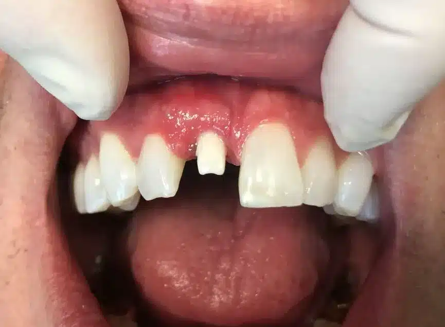 Implantes dentales estándar - Antes