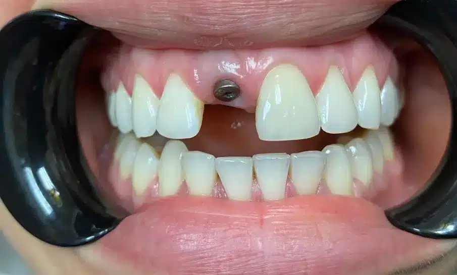 Standard Dental Implants - Before