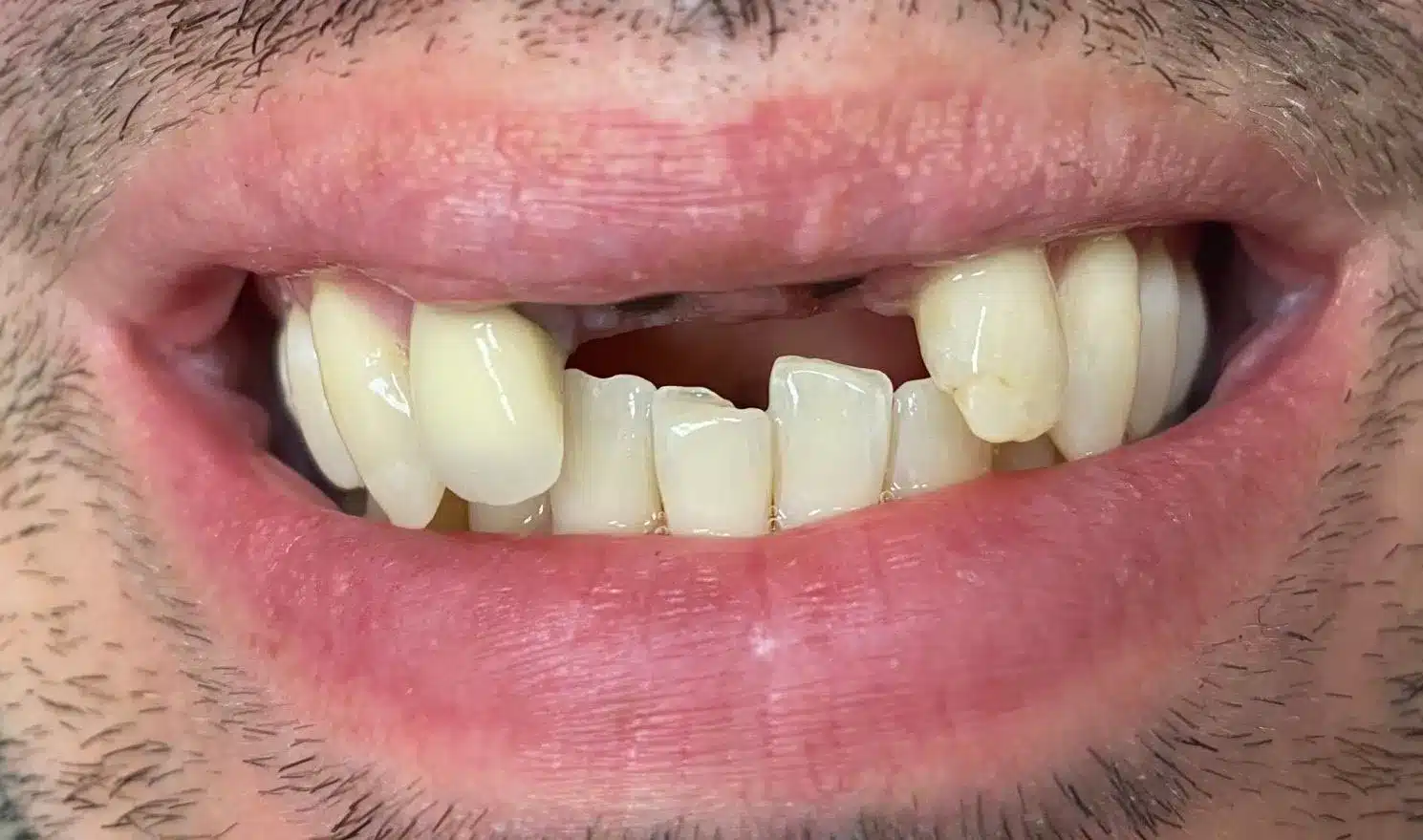 Standard Dental Implants - Before