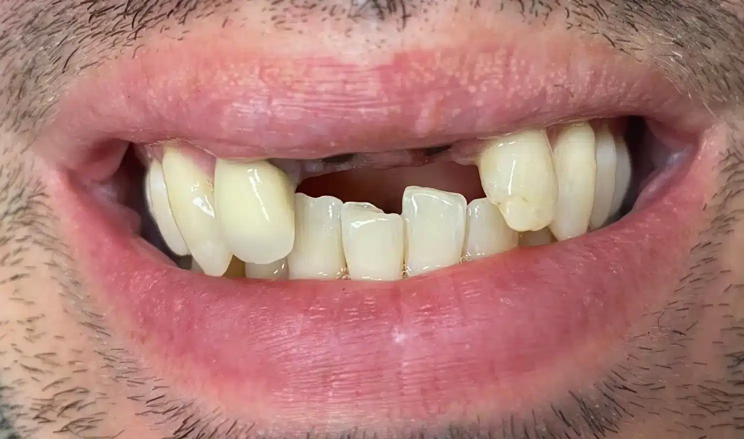 Implantes dentales estándar - Antes