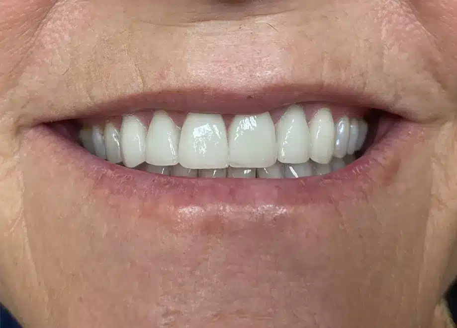 Veneers After