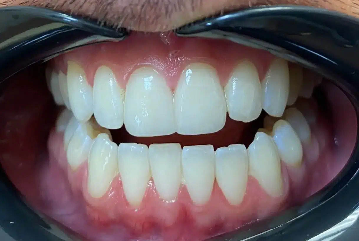 Veneers After