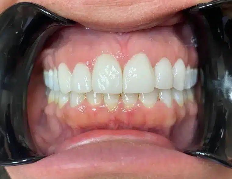 Veneers After