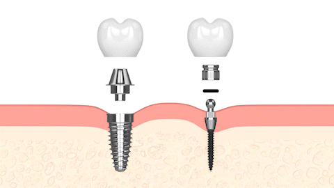 Dental Implants in Austin, TX | Tooth Replacement | Mini Implant