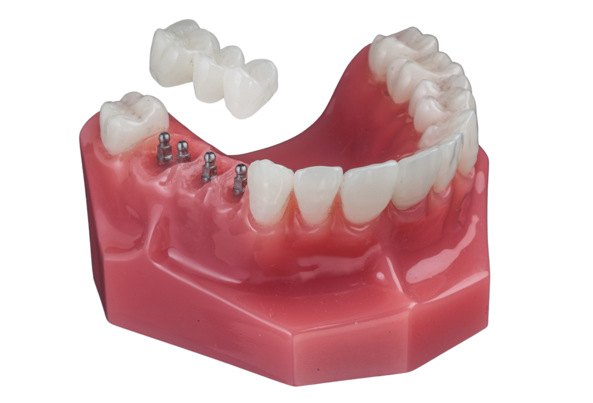 Puentes de Implantes en Austin, TX | Mini Implantes Dentales | Dr. Hall