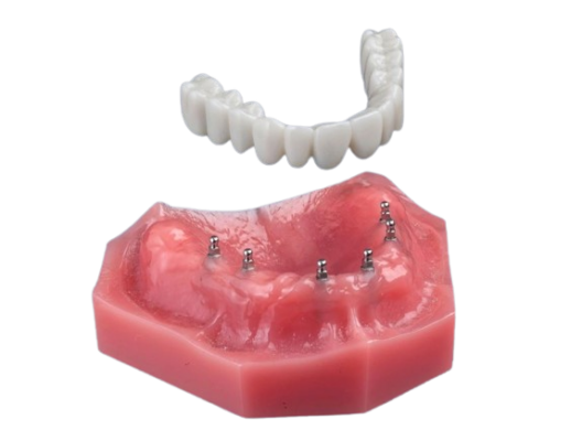 Implant Dentures in Austin, TX | Mini Implants | Tooth Replacement