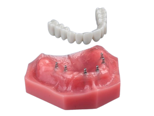 Implant Dentures in Austin, TX | Mini Implants | Tooth Replacement