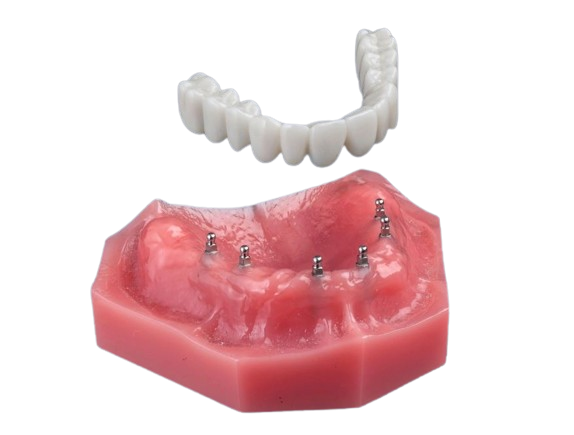 Implant Dentures in Austin, TX | Mini Implants | Tooth Replacement