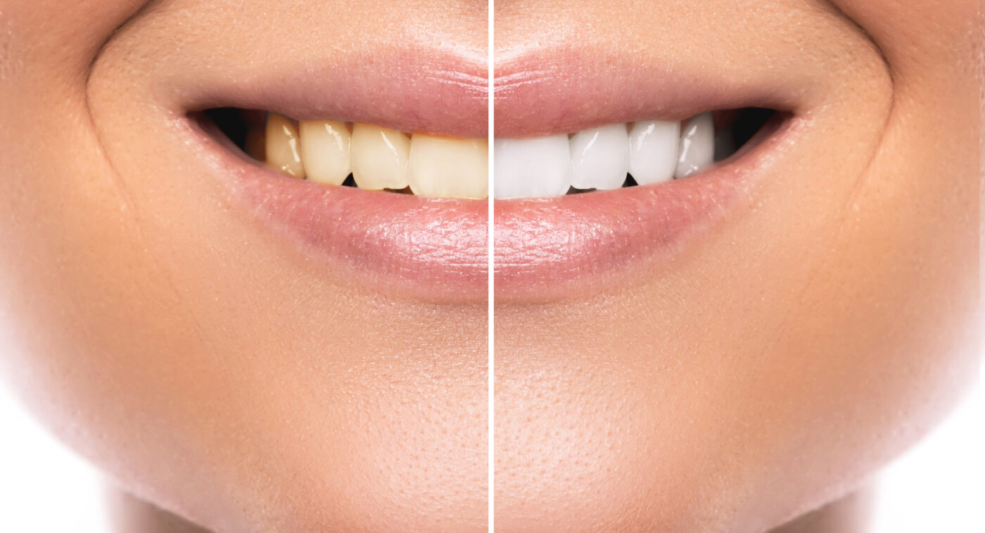 Blanqueamiento Dental en Austin, TX | Blanqueamiento Dental | Smile Makeover