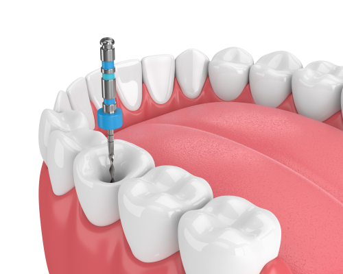 Root Canal Treatment in Austin, TX Pain Relief Dr. Brandon Hall