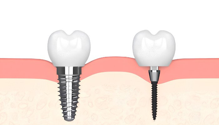 Dental Implants in Wells Branch, TX | Book Your Free Consultation!