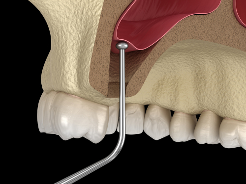 Elevación de seno en Austin TX | Reserve hoy una consulta gratuita sobre implantes